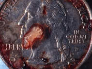 7 Week Abortion (04)