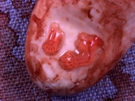 7 Week Abortion (01)