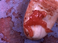 7 Week Abortion (02)