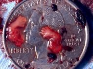 8 Week Abortion (07)
