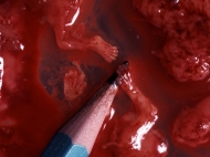 8 Week Abortion (03)