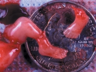 10 Week Abortion (03)