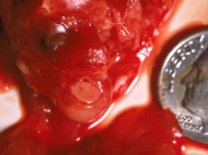 10 Week Abortion (04)