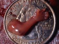 10 Week Abortion (07)
